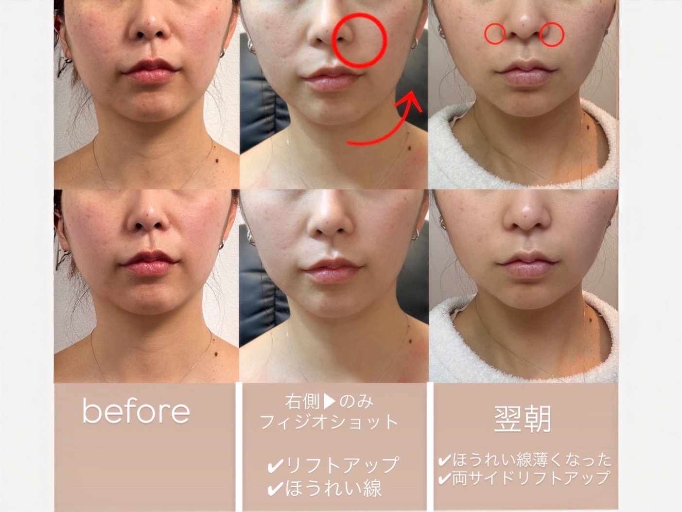 フィジオショット顔施術のビフォーアフター